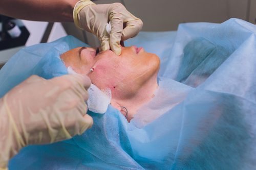 Lipofilling des pommettes Lipofilling des pommettes