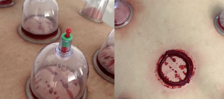Hijama