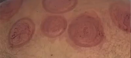 Hijama