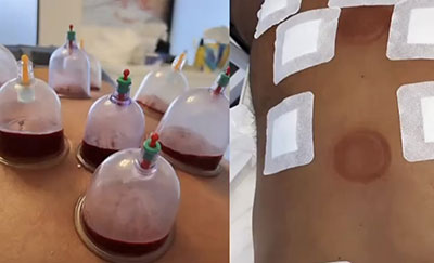 Hijama