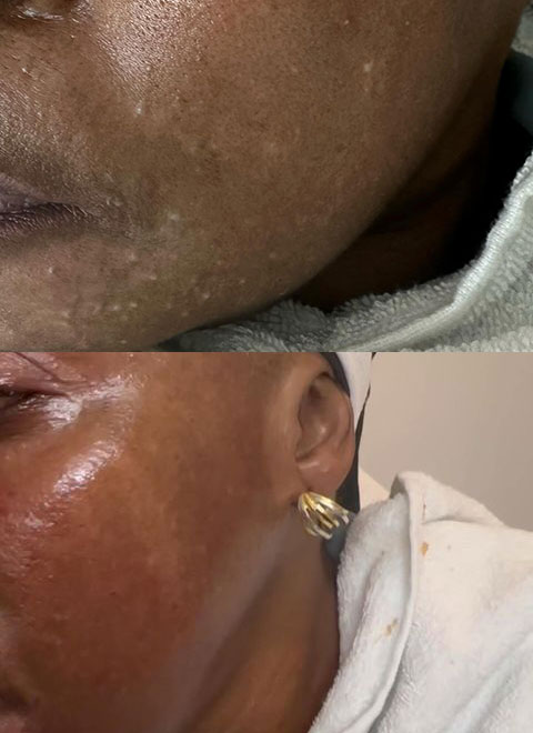 microdermabrasion