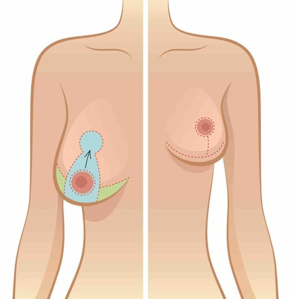 Réduction Mammaire Réduction Mammaire