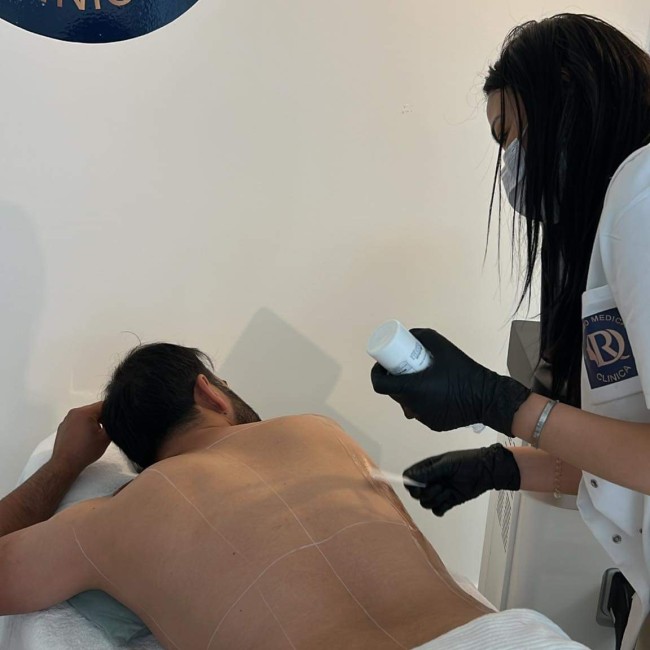 Epilation définitive laser du Dos