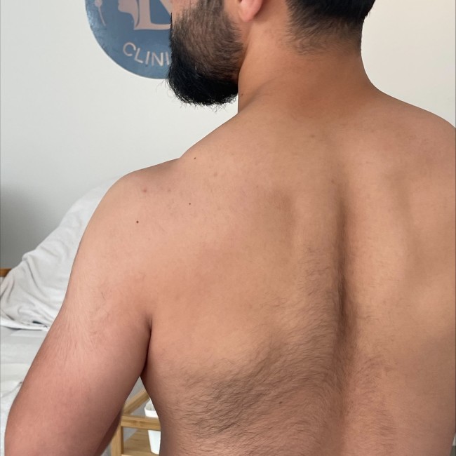 Epilation définitive laser du Dos