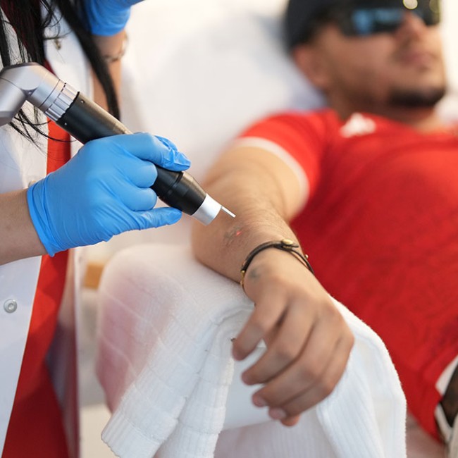 Pico Laser Tattoo Removal in Brussels