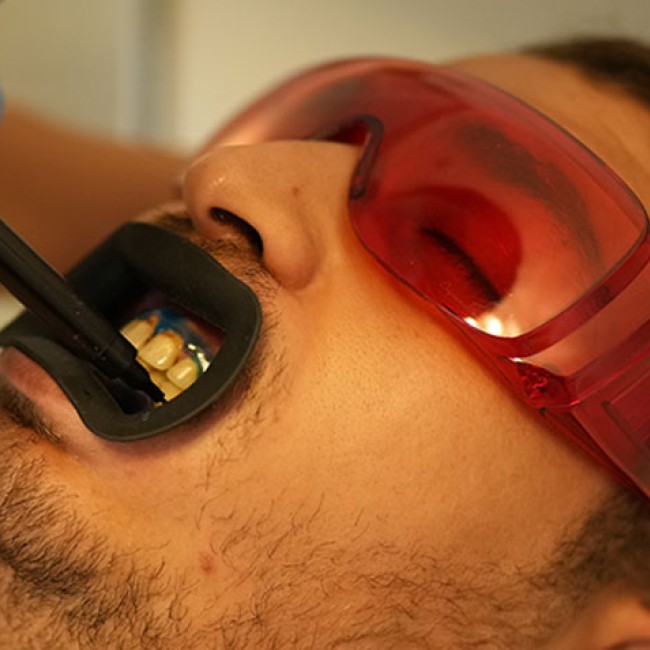 Laser tooth whitening