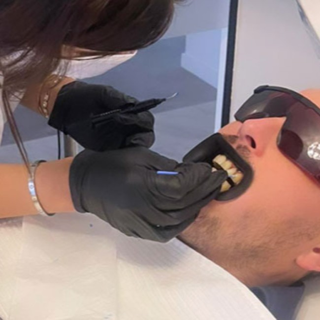 Laser tooth whitening