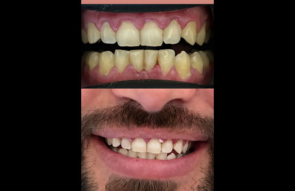 Laser tooth whitening