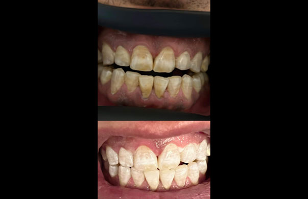 Laser tooth whitening