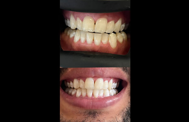 Laser tooth whitening