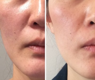 Nasolabial folds - injection (price per syringe)